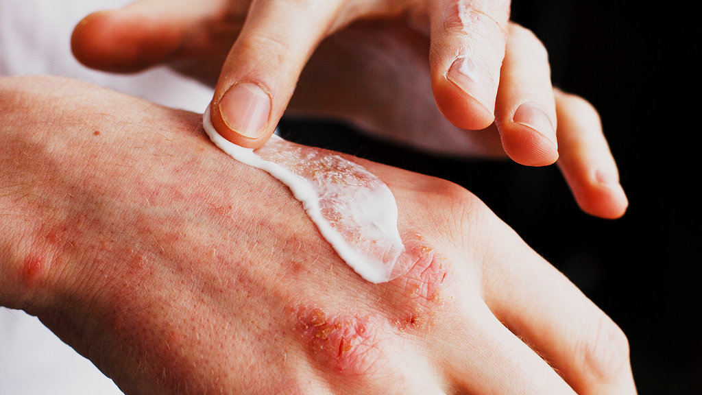 Mugwort: A Natural Relief for Eczema